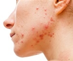 Individuals with acne face stigmatizing attitudes from the general public, study finds