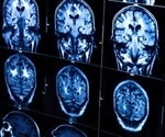 Brain bleeds in older adults linked to amyloid deposits in blood vessels