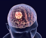 Research paves way for clinical trials of existing drugs for brain metastasis