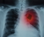 Improving lung cancer surgery through novel computed tomography