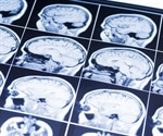 Football linked to more brain damage beyond white matter marks